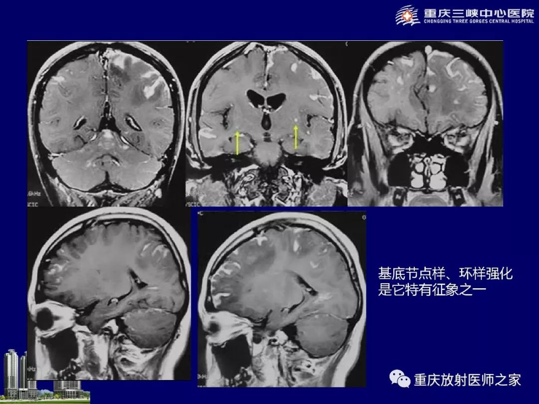 影像PPT - 【PPT】脑内环形强化病变的影像诊断思路-65