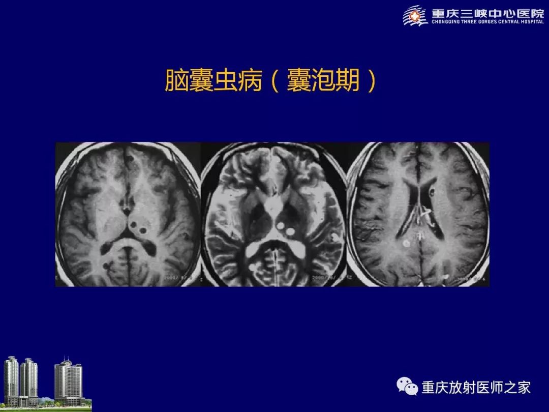 影像PPT - 【PPT】脑内环形强化病变的影像诊断思路-70