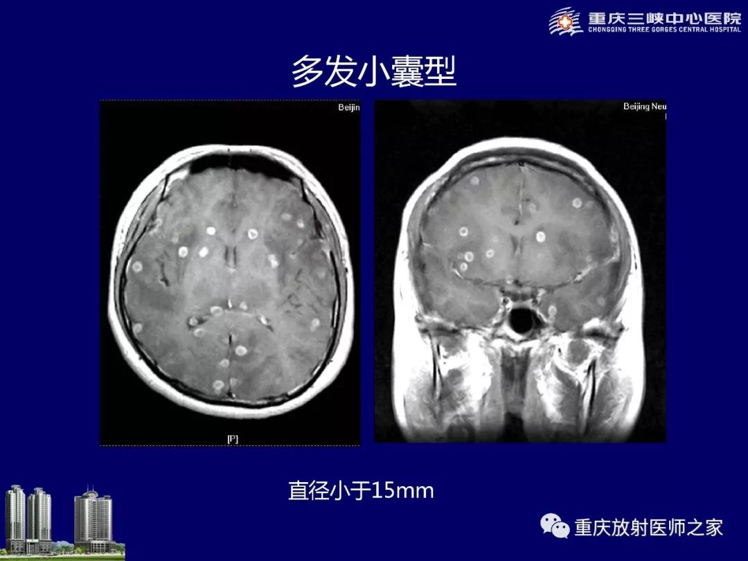 影像PPT - 【PPT】脑内环形强化病变的影像诊断思路-72
