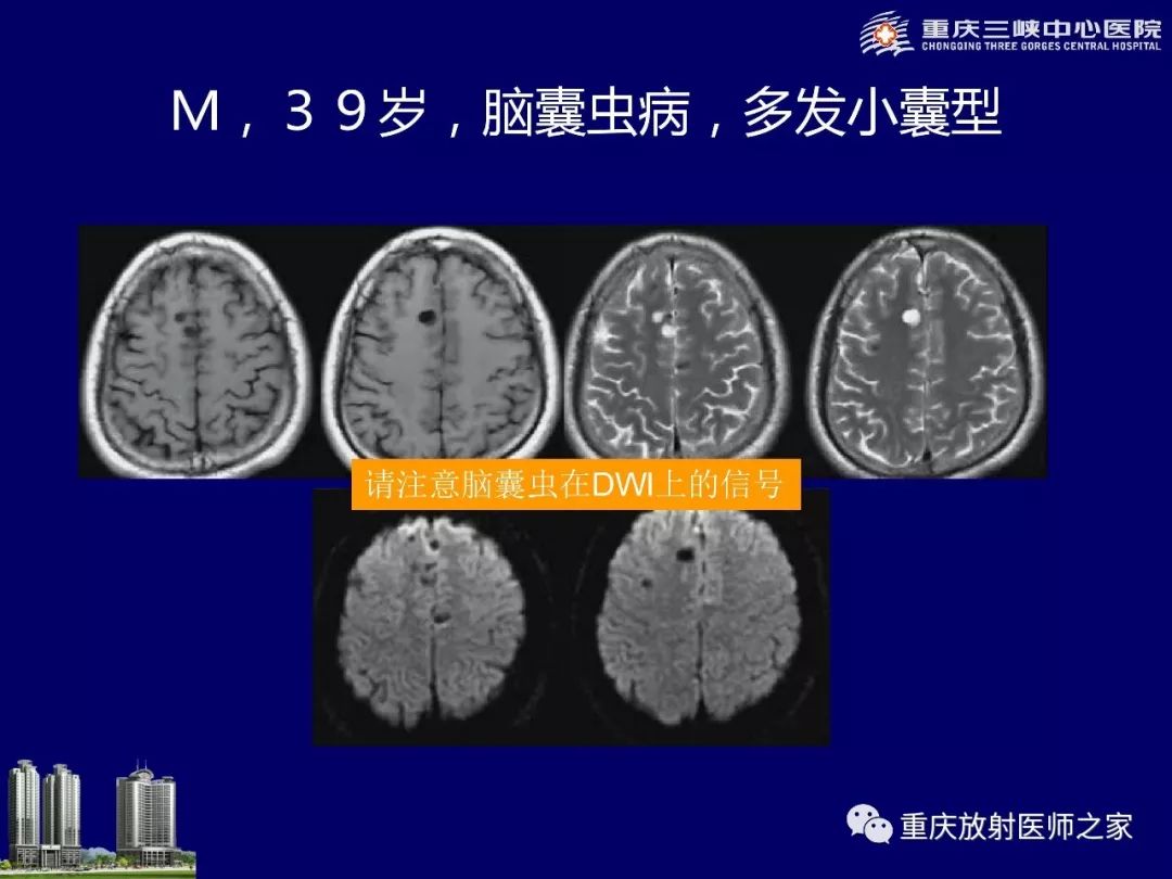 影像PPT - 【PPT】脑内环形强化病变的影像诊断思路-74