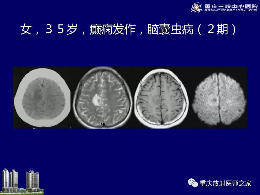 影像PPT - 【PPT】脑内环形强化病变的影像诊断思路-75