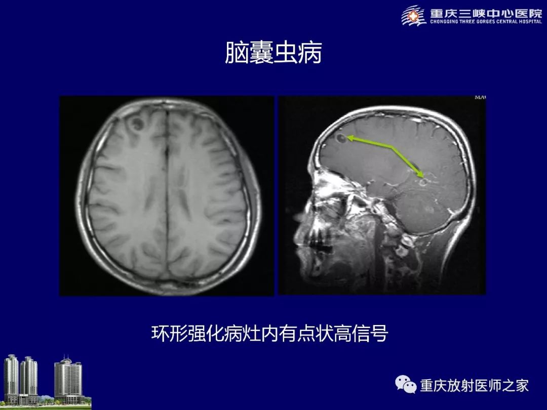 影像PPT - 【PPT】脑内环形强化病变的影像诊断思路-71