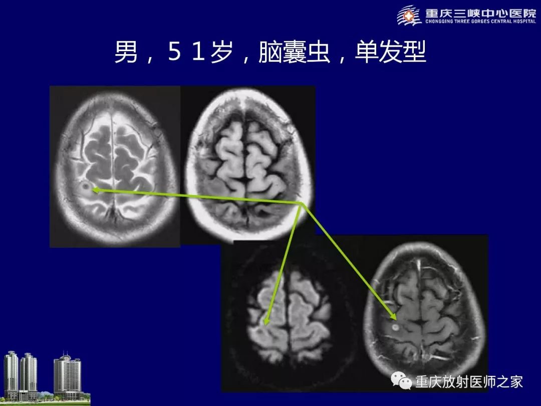 影像PPT - 【PPT】脑内环形强化病变的影像诊断思路-76