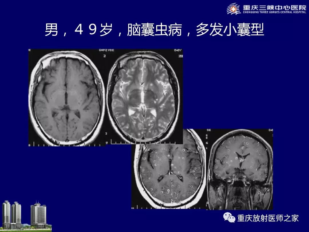 影像PPT - 【PPT】脑内环形强化病变的影像诊断思路-73