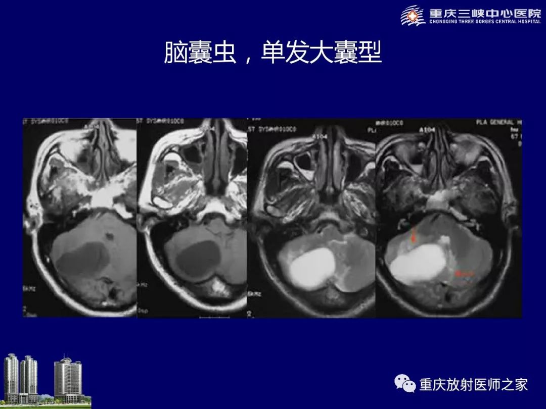 影像PPT - 【PPT】脑内环形强化病变的影像诊断思路-77