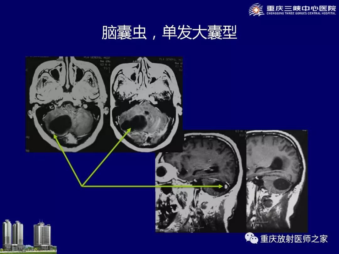 影像PPT - 【PPT】脑内环形强化病变的影像诊断思路-78