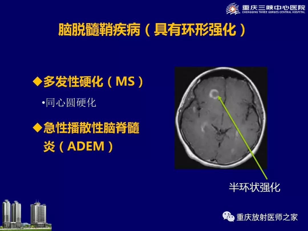 影像PPT - 【PPT】脑内环形强化病变的影像诊断思路-80