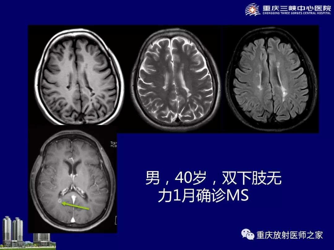影像PPT - 【PPT】脑内环形强化病变的影像诊断思路-82