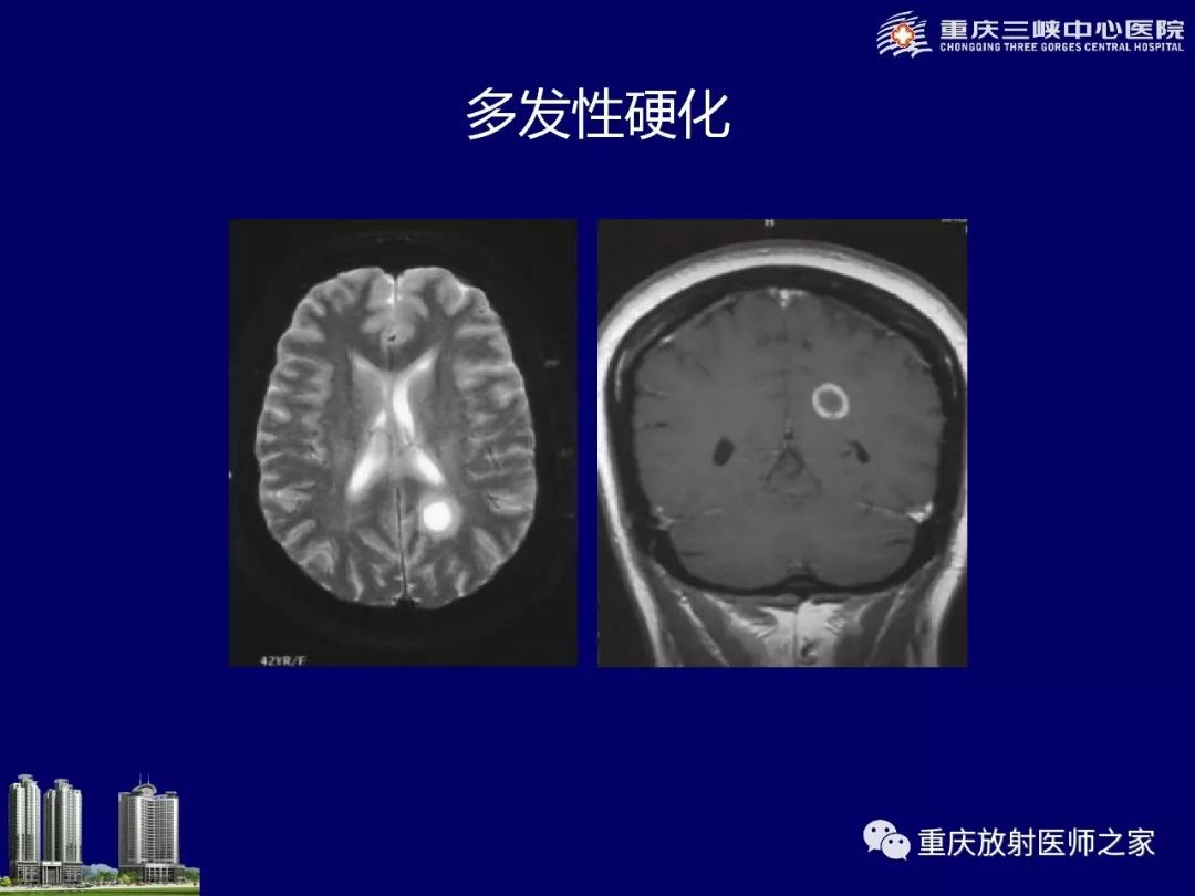 影像PPT - 【PPT】脑内环形强化病变的影像诊断思路-83