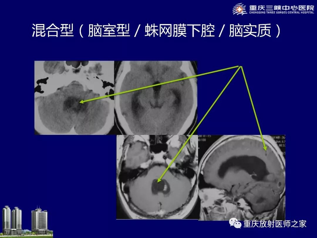 影像PPT - 【PPT】脑内环形强化病变的影像诊断思路-79
