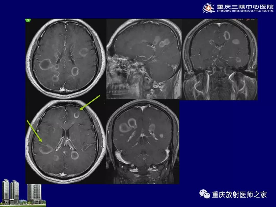 影像PPT - 【PPT】脑内环形强化病变的影像诊断思路-86