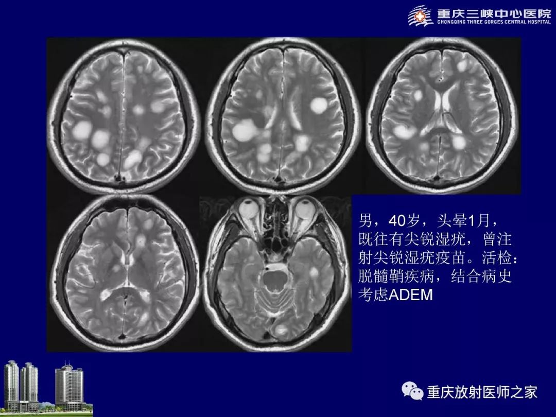影像PPT - 【PPT】脑内环形强化病变的影像诊断思路-85