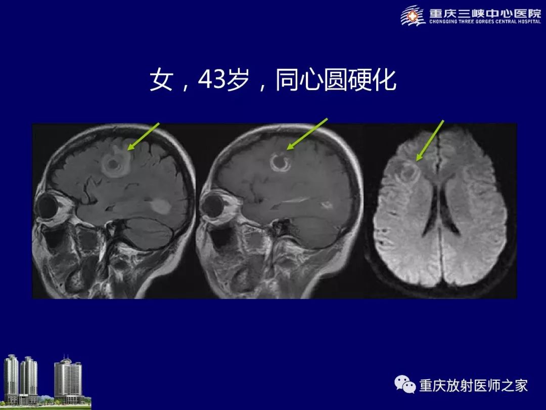 影像PPT - 【PPT】脑内环形强化病变的影像诊断思路-84