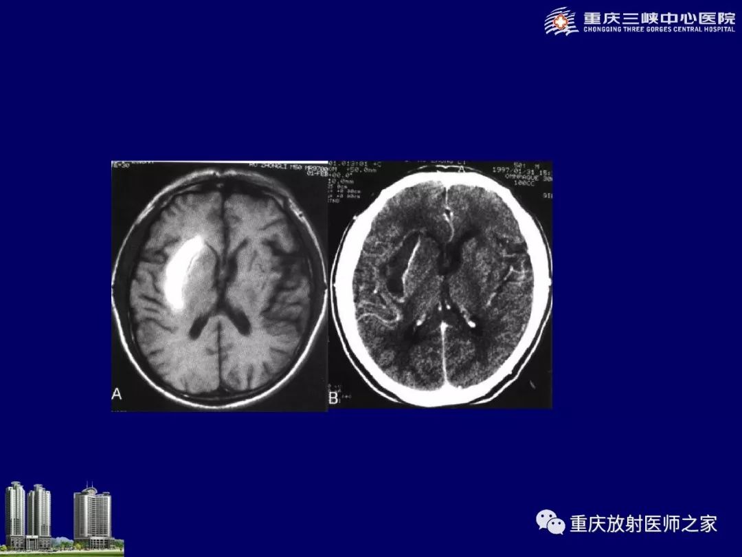 影像PPT - 【PPT】脑内环形强化病变的影像诊断思路-89
