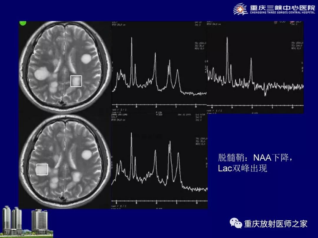 影像PPT - 【PPT】脑内环形强化病变的影像诊断思路-87