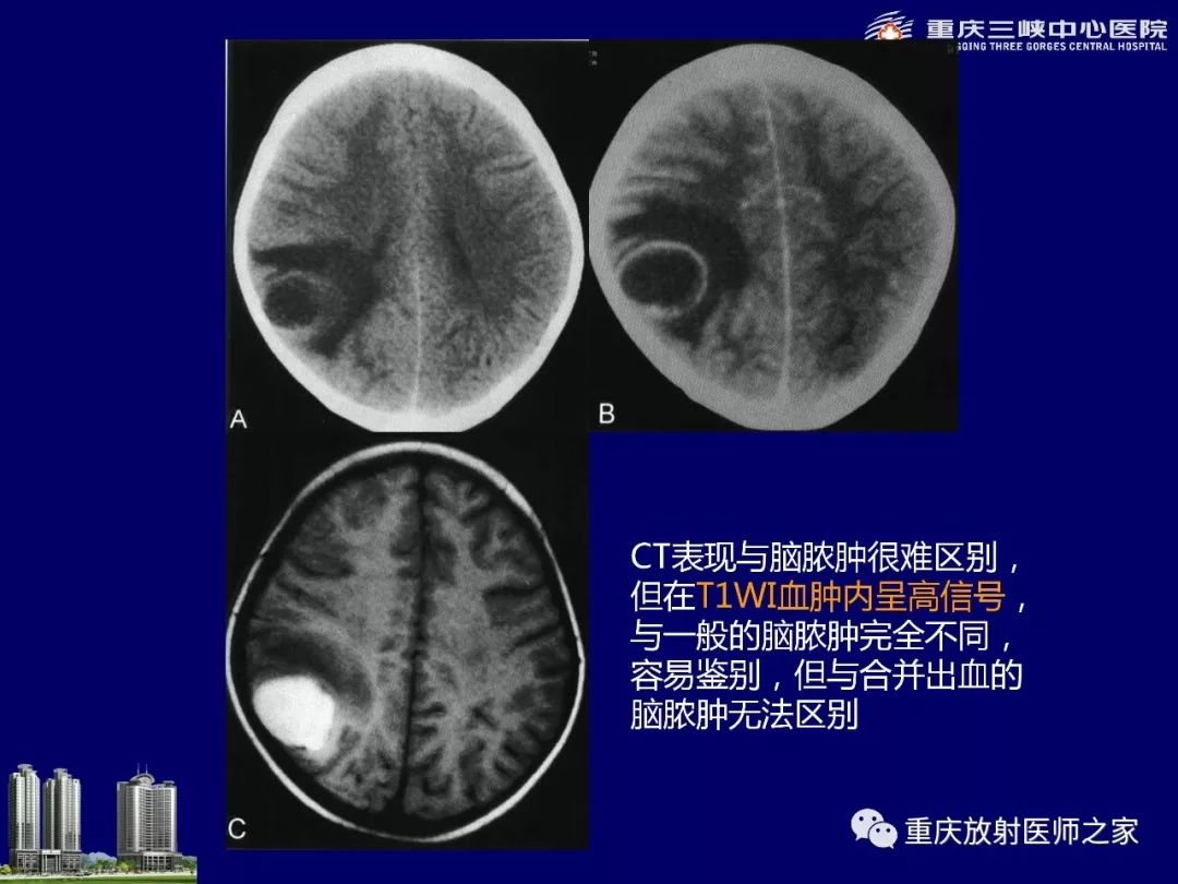影像PPT - 【PPT】脑内环形强化病变的影像诊断思路-93
