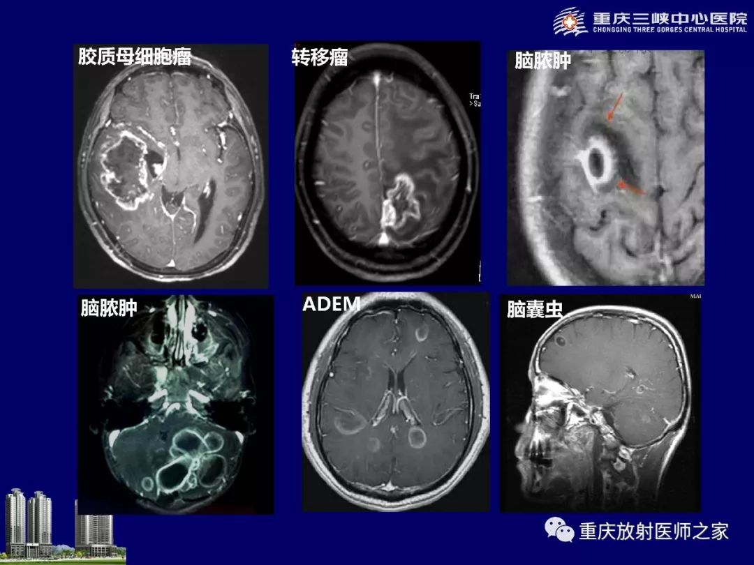 影像PPT - 【PPT】脑内环形强化病变的影像诊断思路-96