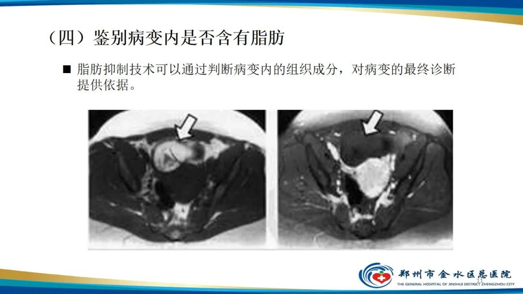 影像PPT - 【PPT】MRI脂肪抑制技术与相关临床应用浅述-11