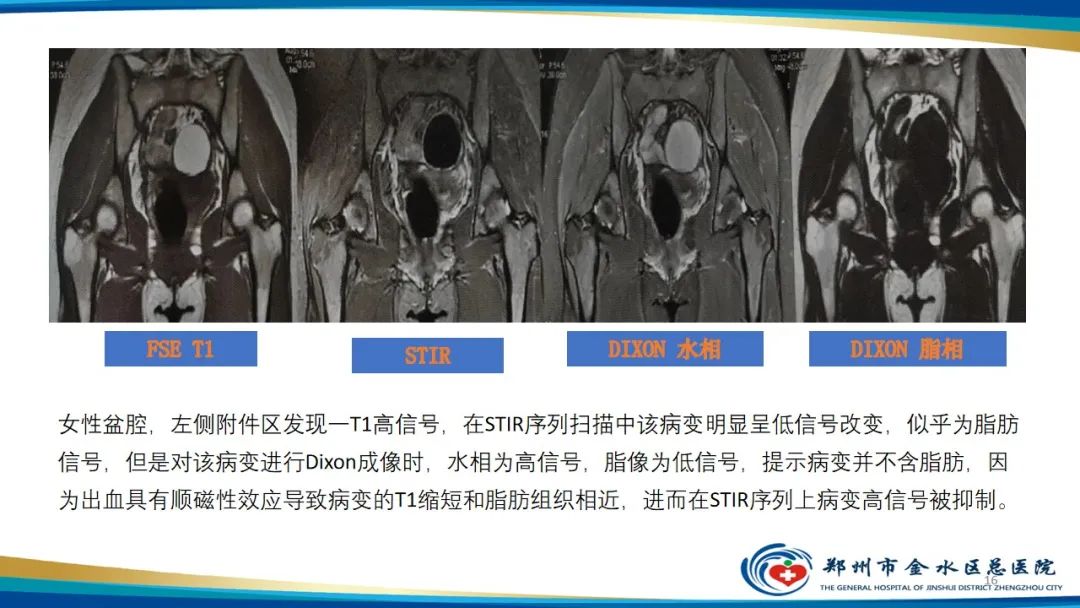 影像PPT - 【PPT】MRI脂肪抑制技术与相关临床应用浅述-16