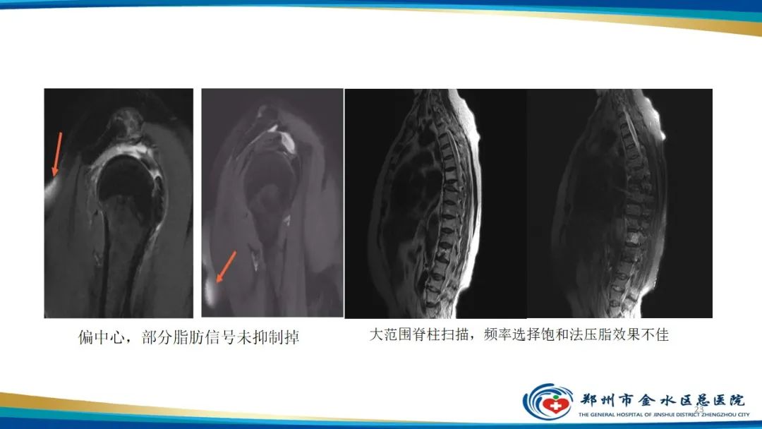影像PPT - 【PPT】MRI脂肪抑制技术与相关临床应用浅述-23