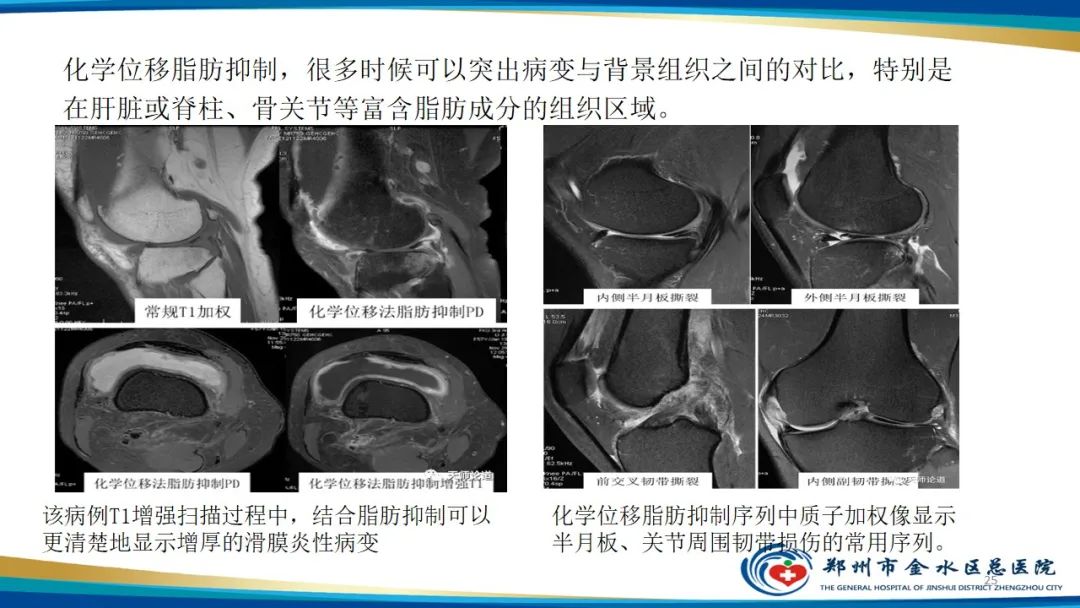 影像PPT - 【PPT】MRI脂肪抑制技术与相关临床应用浅述-25