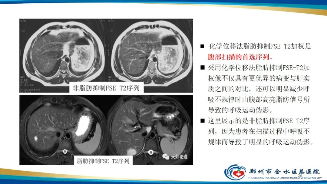 影像PPT - 【PPT】MRI脂肪抑制技术与相关临床应用浅述-26