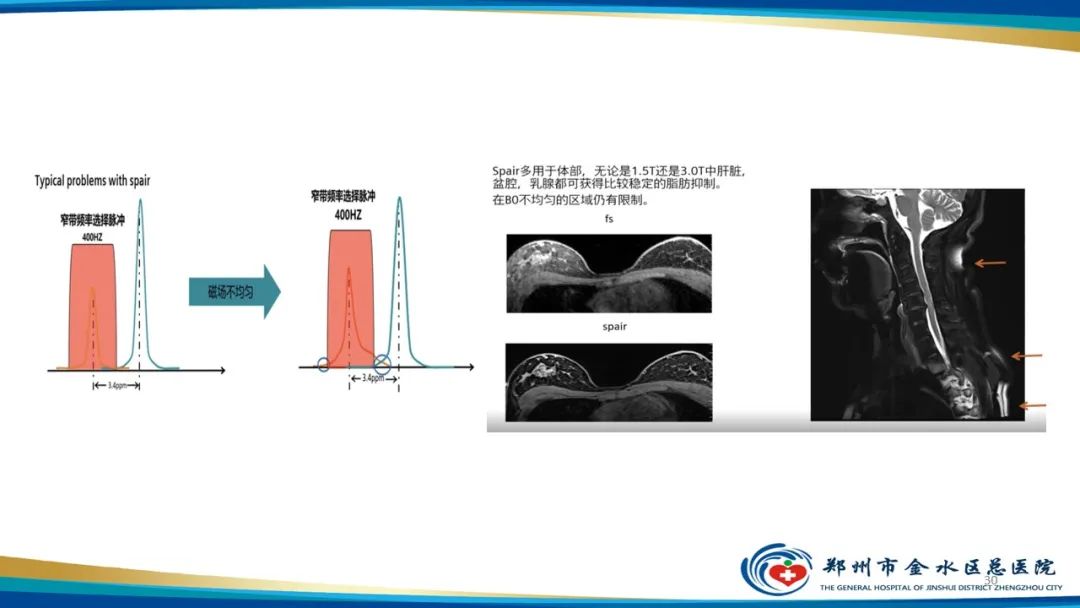 影像PPT - 【PPT】MRI脂肪抑制技术与相关临床应用浅述-30