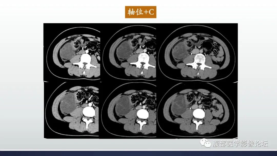 影像PPT - 【病例】良性多囊性腹膜间皮瘤1例CT影像-4