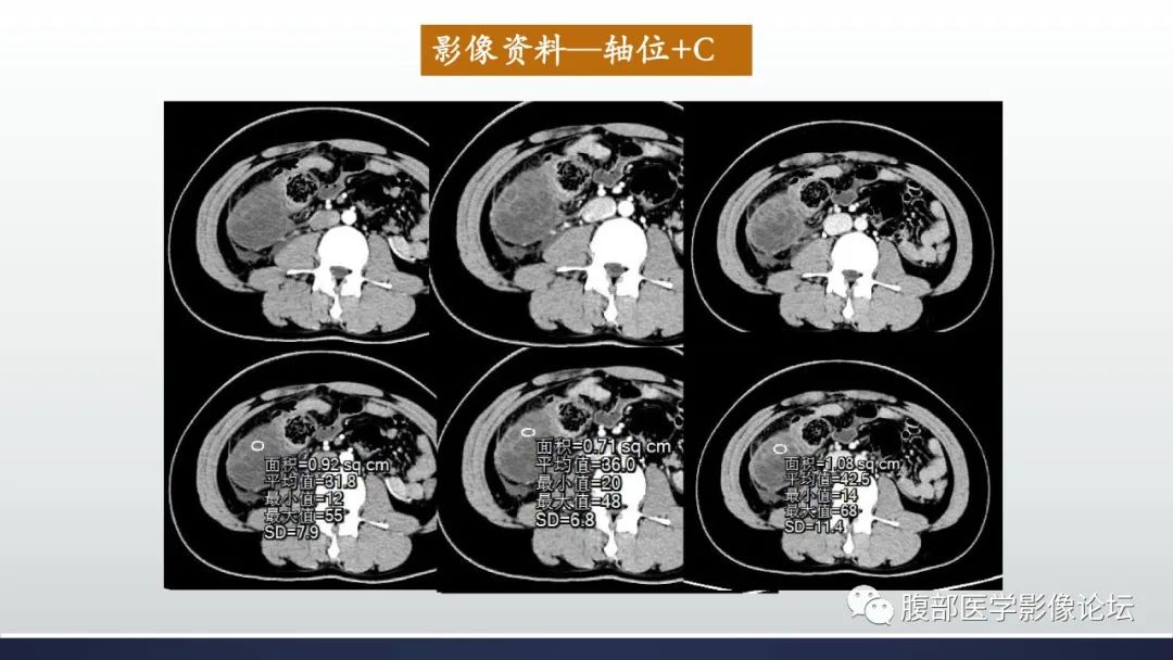 影像PPT - 【病例】良性多囊性腹膜间皮瘤1例CT影像-3