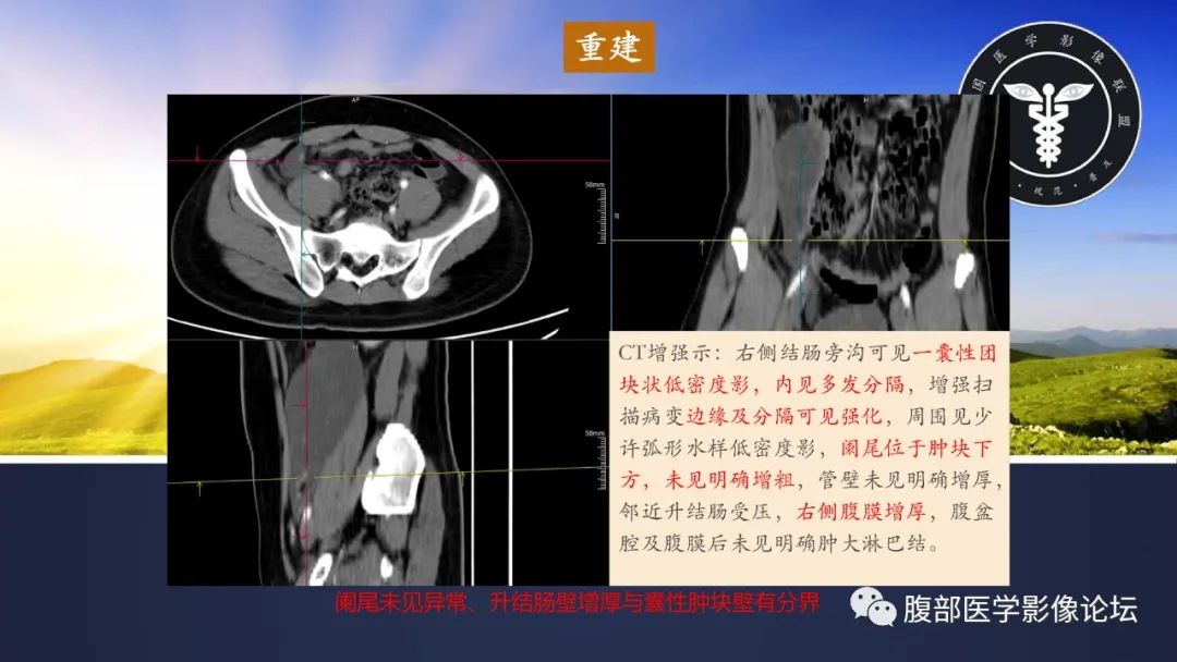 影像PPT - 【病例】良性多囊性腹膜间皮瘤1例CT影像-6