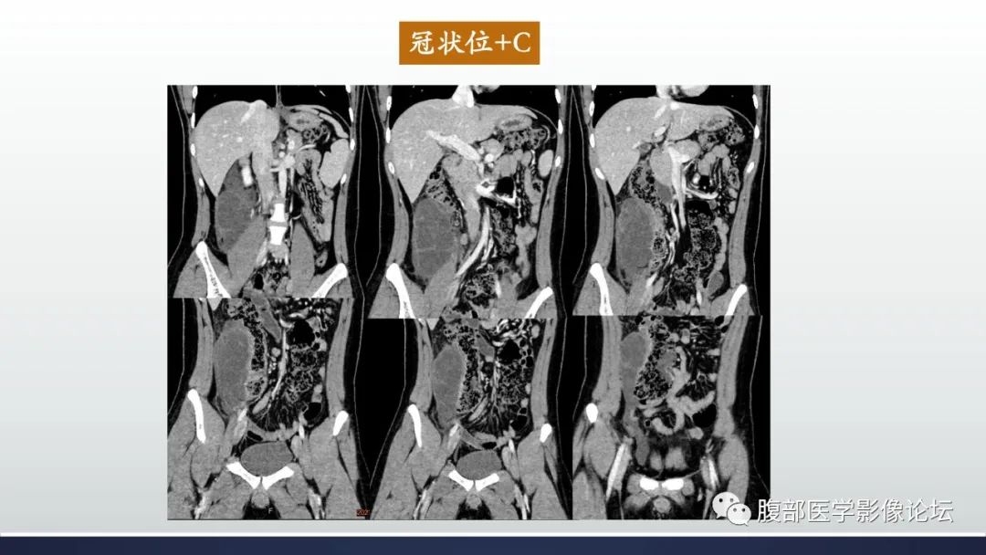 影像PPT - 【病例】良性多囊性腹膜间皮瘤1例CT影像-5