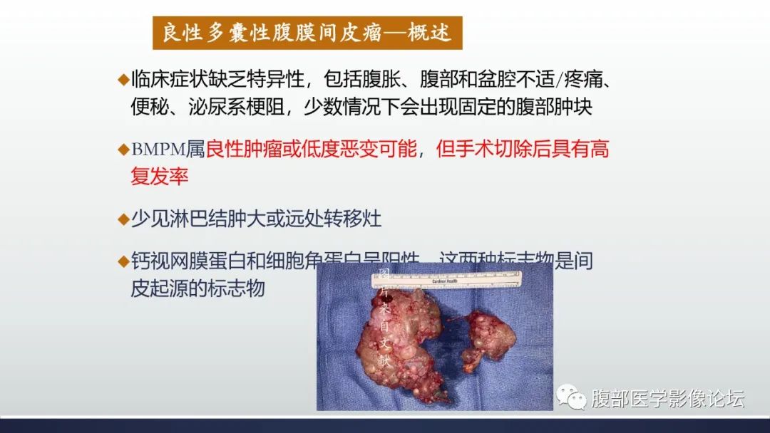 影像PPT - 【病例】良性多囊性腹膜间皮瘤1例CT影像-18
