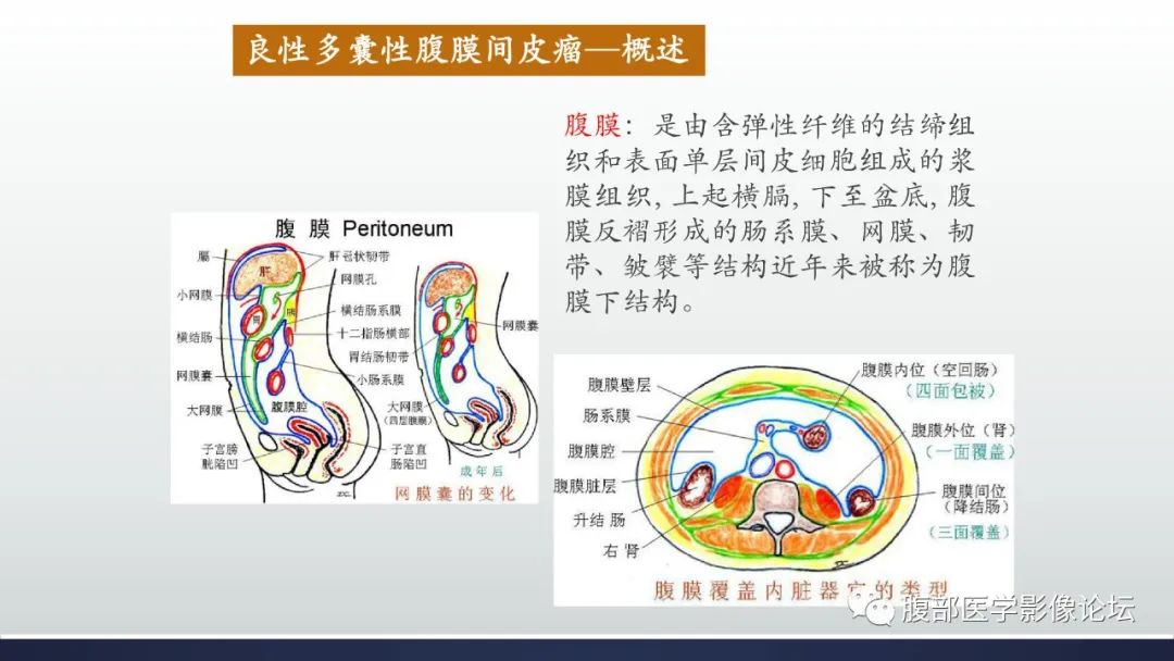 影像PPT - 【病例】良性多囊性腹膜间皮瘤1例CT影像-19