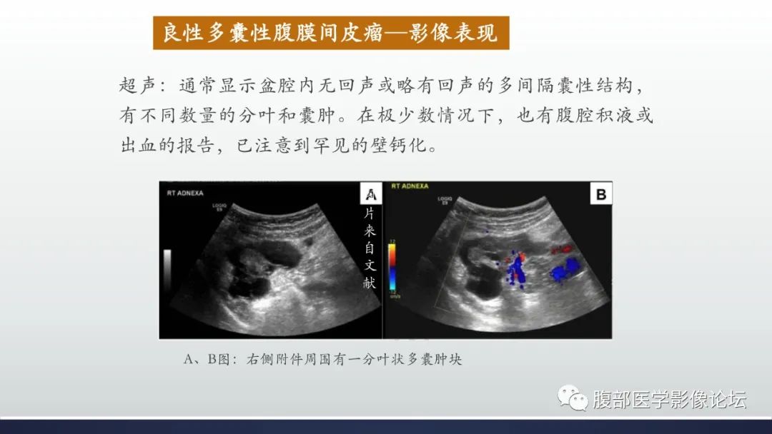 影像PPT - 【病例】良性多囊性腹膜间皮瘤1例CT影像-21