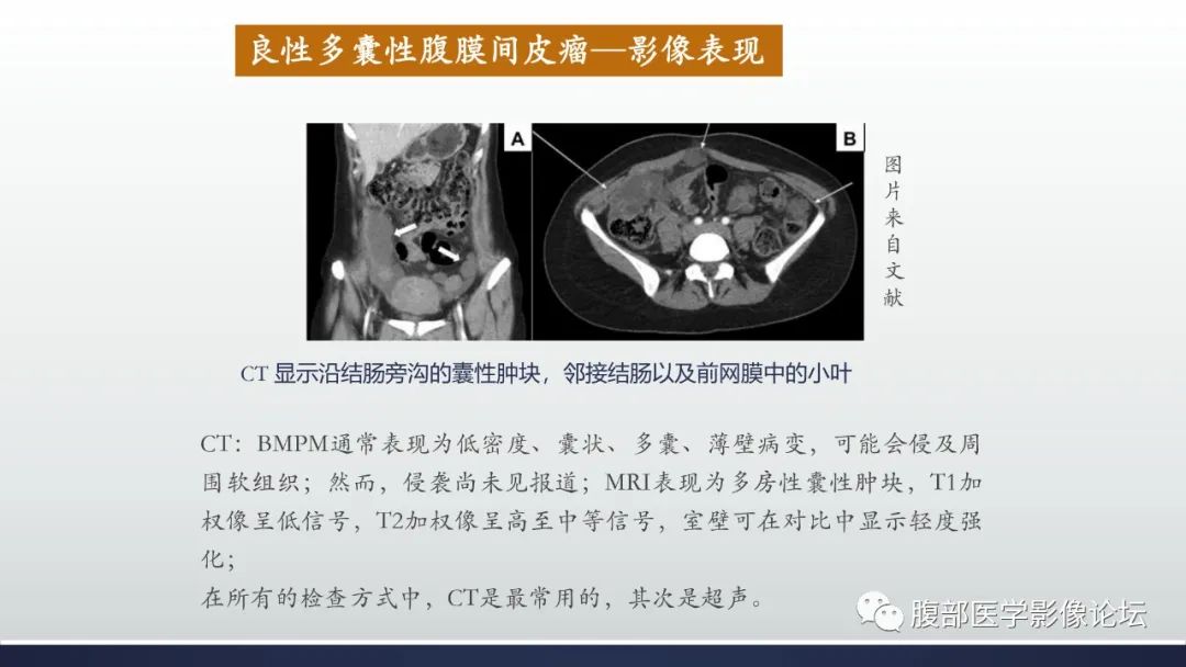 影像PPT - 【病例】良性多囊性腹膜间皮瘤1例CT影像-22