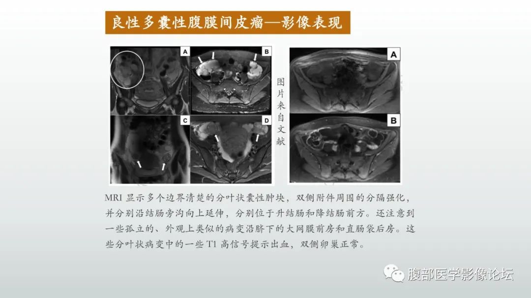 影像PPT - 【病例】良性多囊性腹膜间皮瘤1例CT影像-23