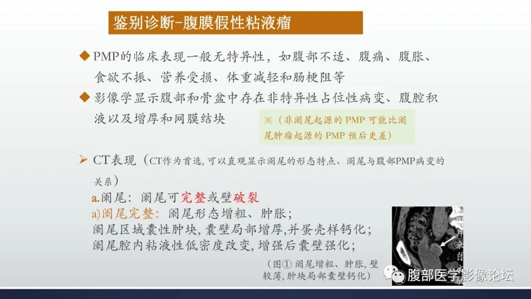 影像PPT - 【病例】良性多囊性腹膜间皮瘤1例CT影像-27