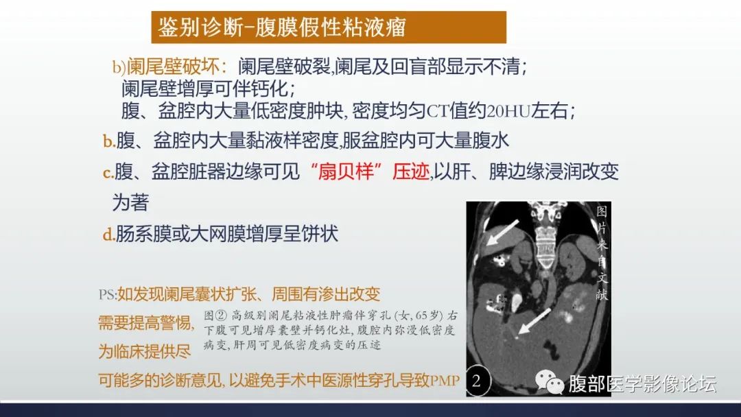 影像PPT - 【病例】良性多囊性腹膜间皮瘤1例CT影像-28