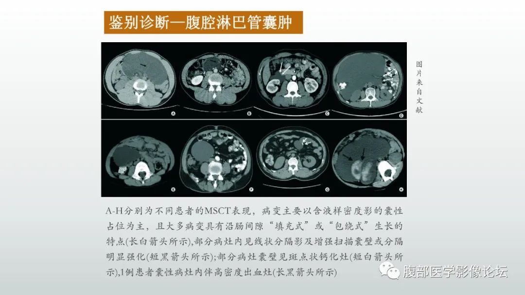 影像PPT - 【病例】良性多囊性腹膜间皮瘤1例CT影像-33