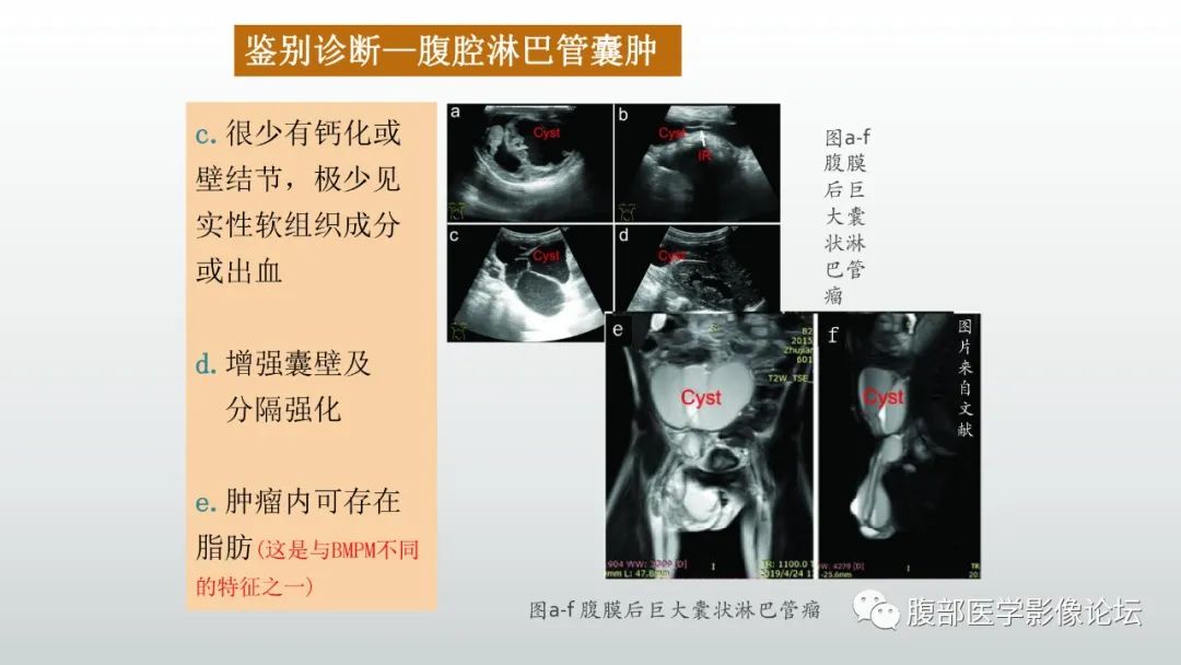 影像PPT - 【病例】良性多囊性腹膜间皮瘤1例CT影像-32