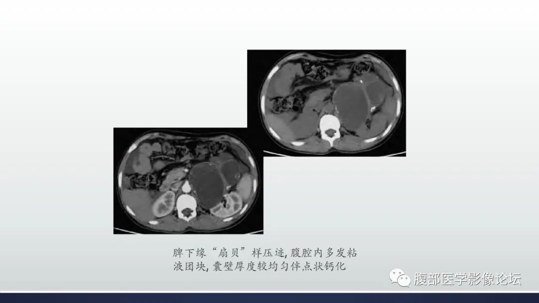影像PPT - 【病例】良性多囊性腹膜间皮瘤1例CT影像-29