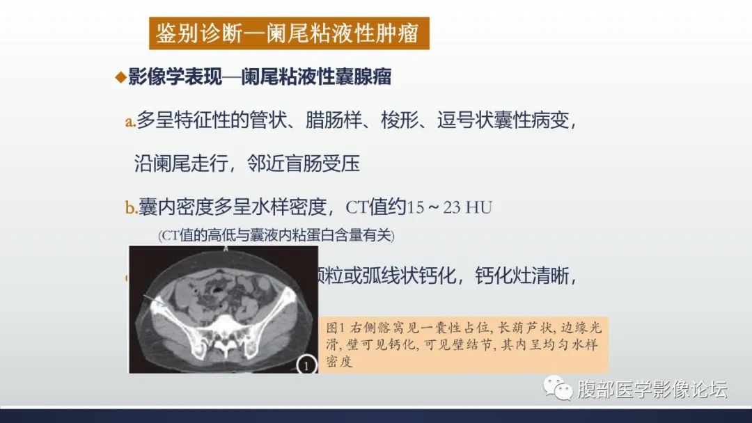 影像PPT - 【病例】良性多囊性腹膜间皮瘤1例CT影像-35
