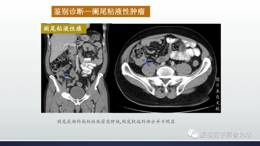 影像PPT - 【病例】良性多囊性腹膜间皮瘤1例CT影像-39