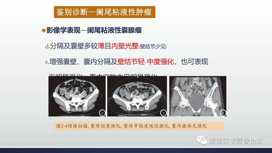 影像PPT - 【病例】良性多囊性腹膜间皮瘤1例CT影像-36