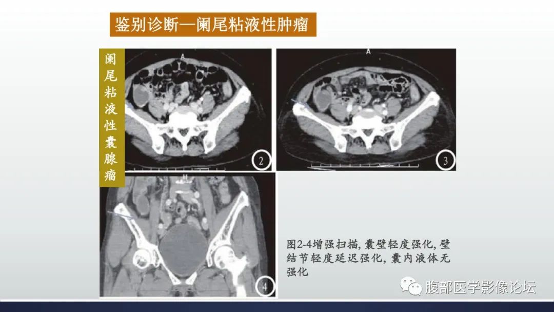 影像PPT - 【病例】良性多囊性腹膜间皮瘤1例CT影像-37