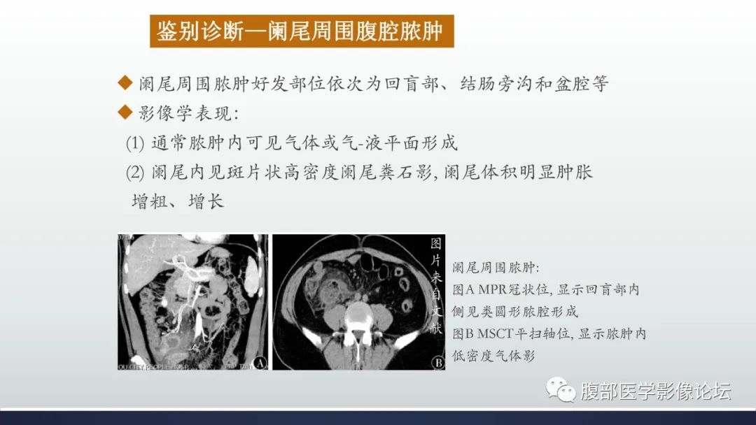 影像PPT - 【病例】良性多囊性腹膜间皮瘤1例CT影像-41
