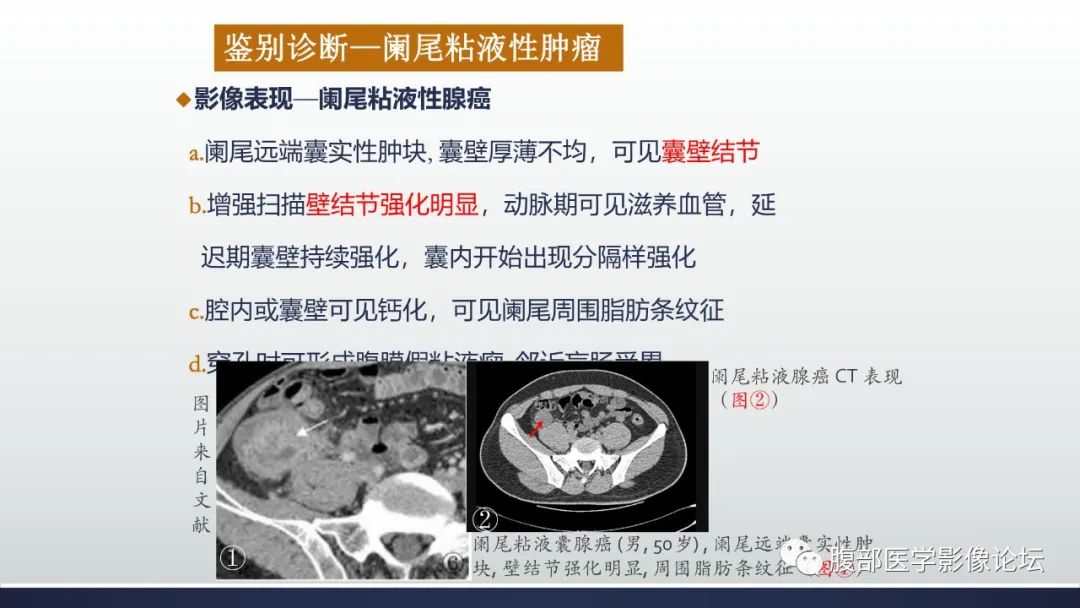影像PPT - 【病例】良性多囊性腹膜间皮瘤1例CT影像-38