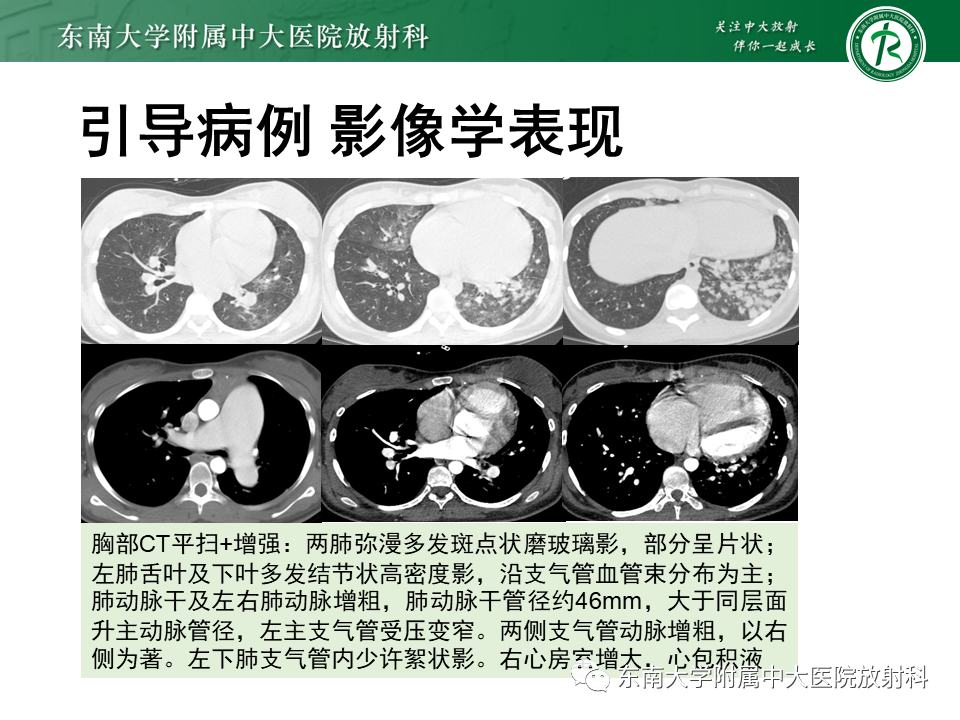 影像PPT - 【PPT】特发性肺动脉高压-2 影像PPT - 【PPT】特发性肺动脉高压-2