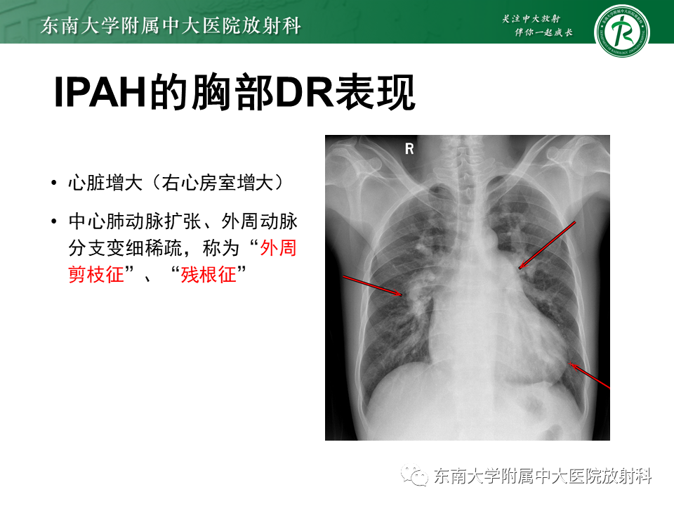 影像PPT - 【PPT】特发性肺动脉高压-18 影像PPT - 【PPT】特发性肺动脉高压-18