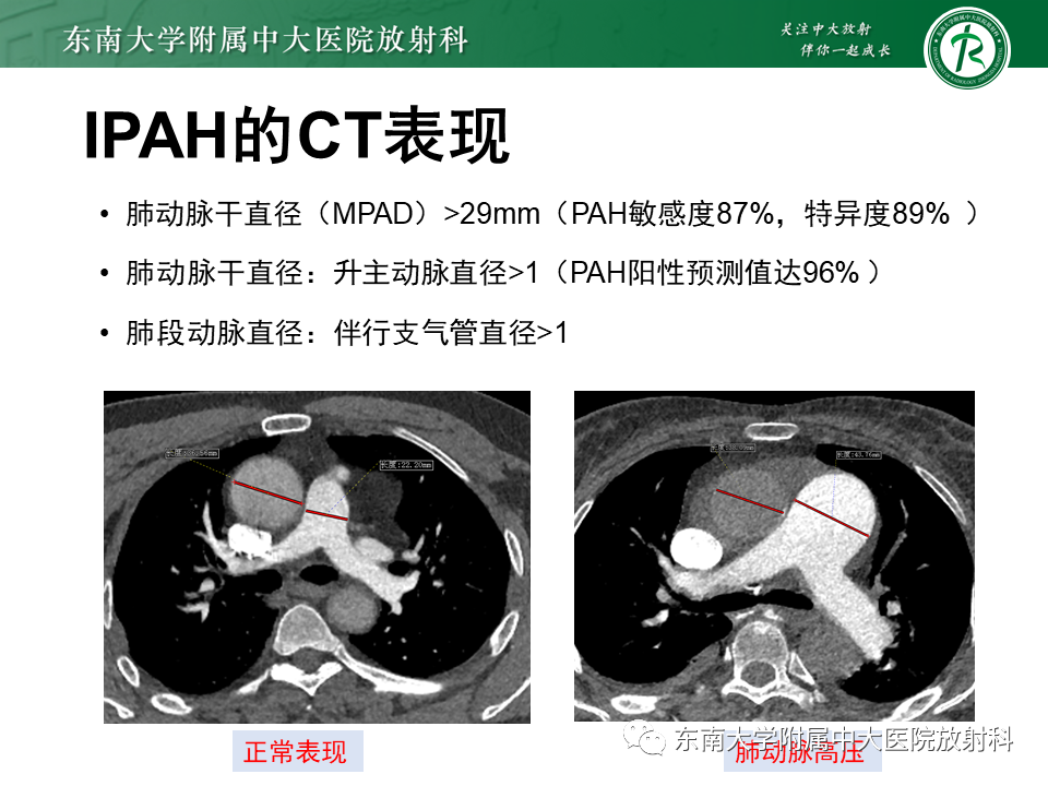 影像PPT - 【PPT】特发性肺动脉高压-19 影像PPT - 【PPT】特发性肺动脉高压-19